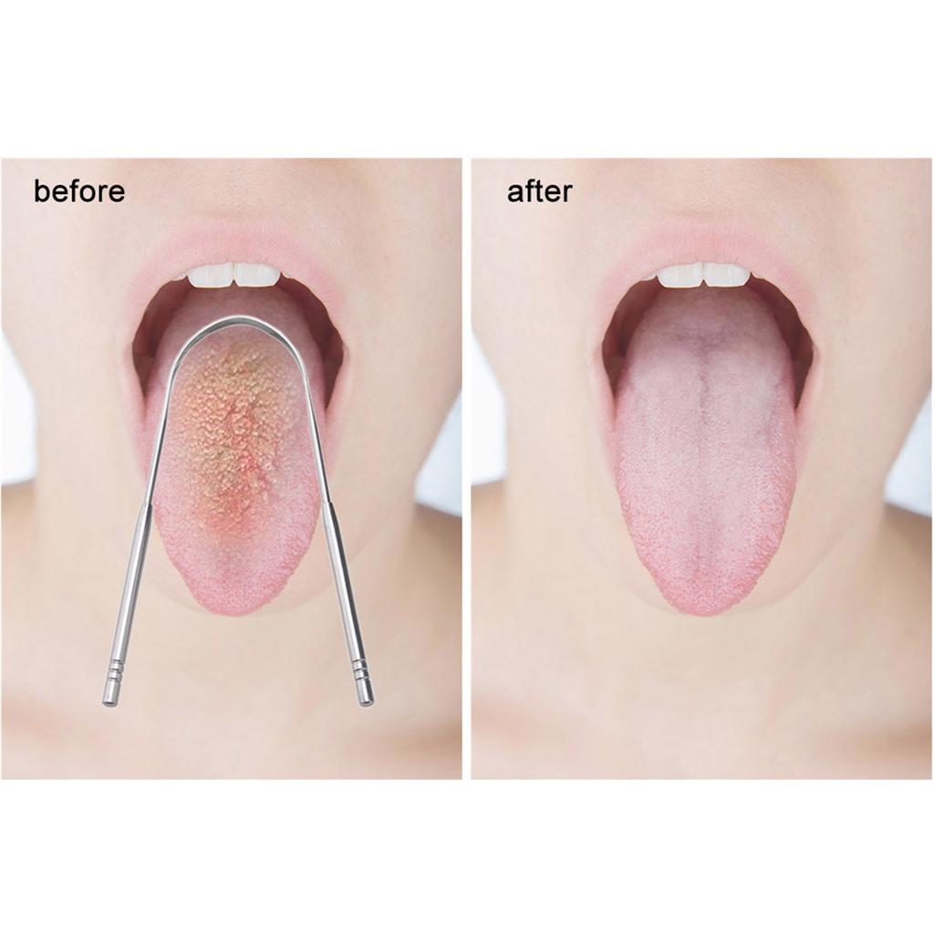 Tongue Scraper 2 Pack In Different Shapes Reduce Bad Breath Stainless Steel Tongue Cleaners Metal