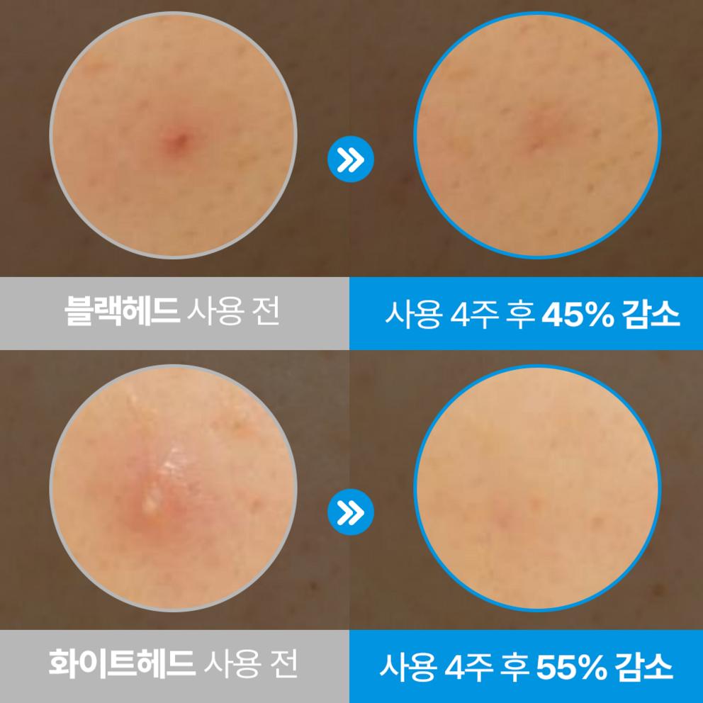 Hiruscar Post Acne Clear Esencja, 10g