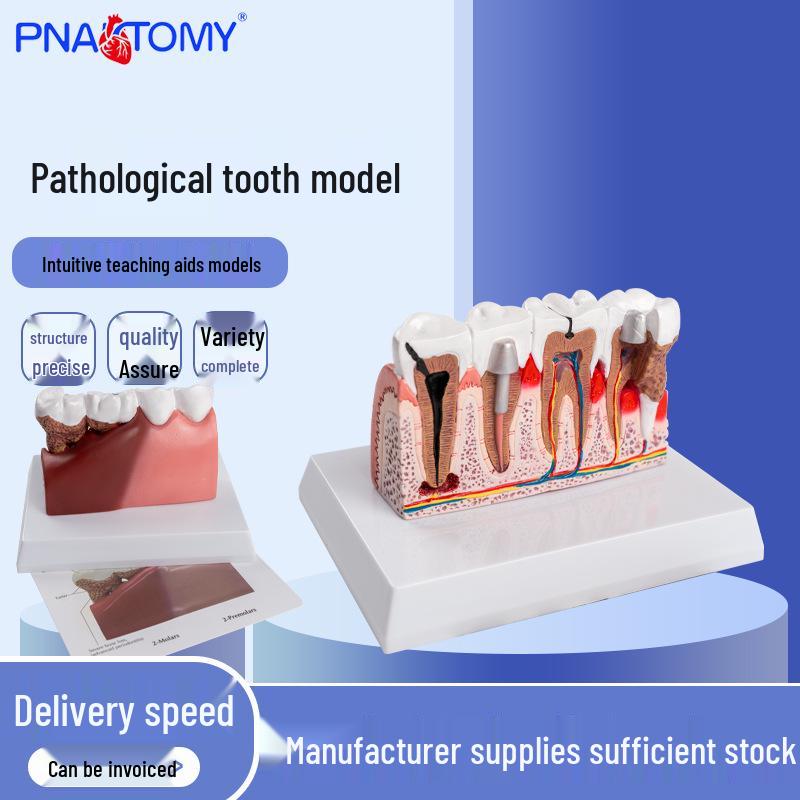 Adult Pathological Tooth and Oral Cavity Dental Teaching Model 18x14x12 cm