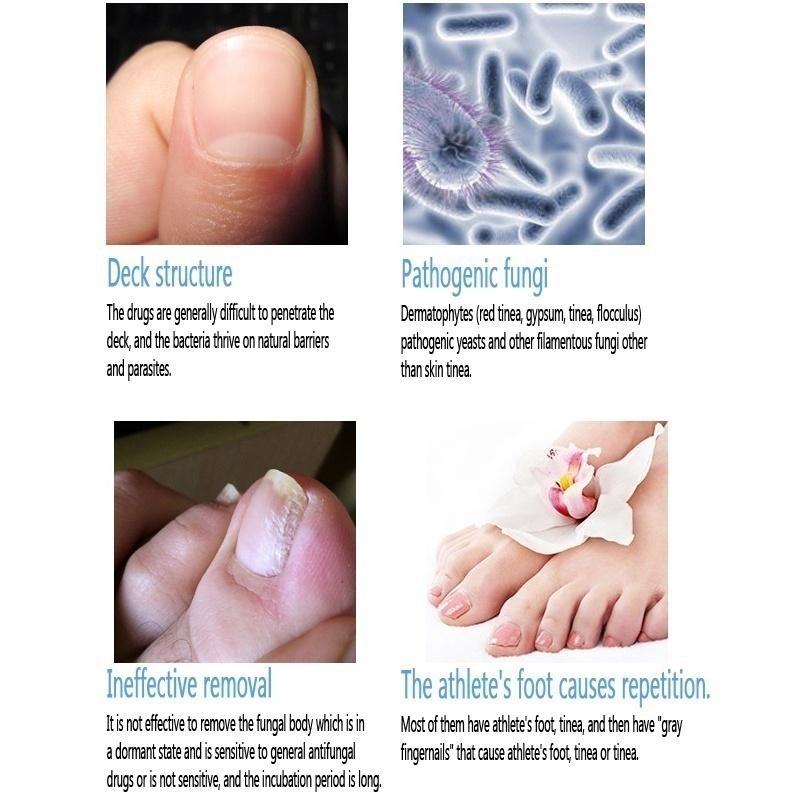 3ml Nail Problem Treatment of Onychomycosis Repair 1 Bottle Bacteriostat  5 Bottles for 30 Days