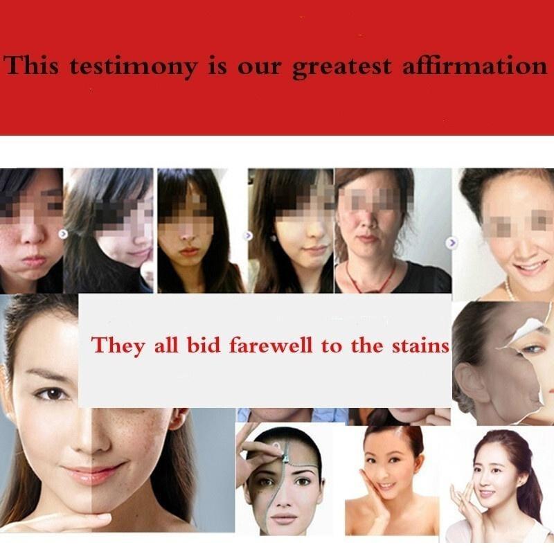 The Latest Horse Oil Freckle Cream, Fade, Stain, Sunburn, Chloasma, Freckles, Facial Care