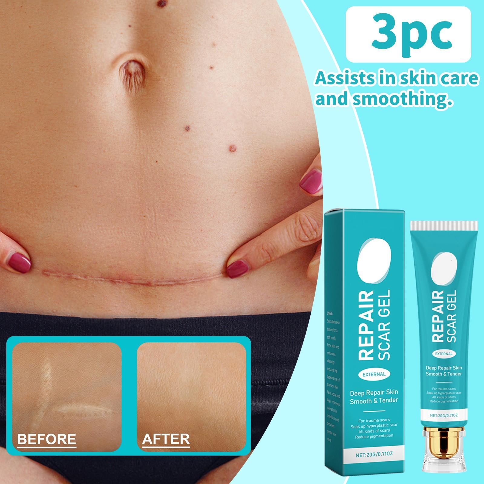 

Крем от шрамов, крем для удаления шрамов для мужчин и женщин, разглаживание кожи, укрепление и исчезновение, глубокое разглаживание кожи, нежное внешнее воздействие всех видов One Size