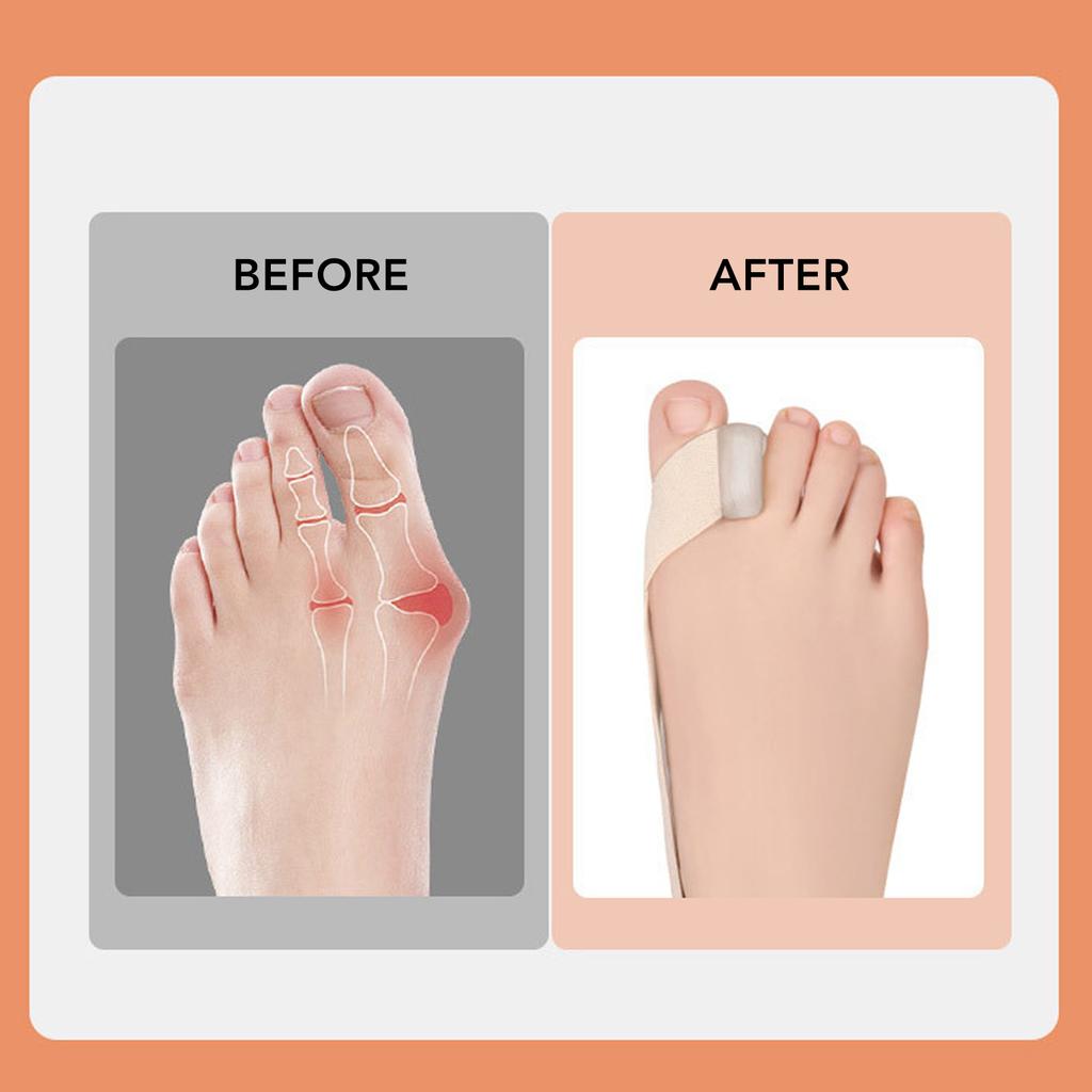 Hallux Vaus Belt Elastic Soft Comfortable Skin Friendly Bunion Corrector Belt for Bunion Overlapping Toes Skin Color