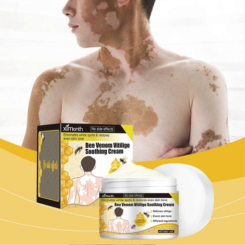 Bee Venom Vitiligo Cream, Natural Anti-Vitiligo Cream for Reduce White Spots & Improve Skin Pigmentation