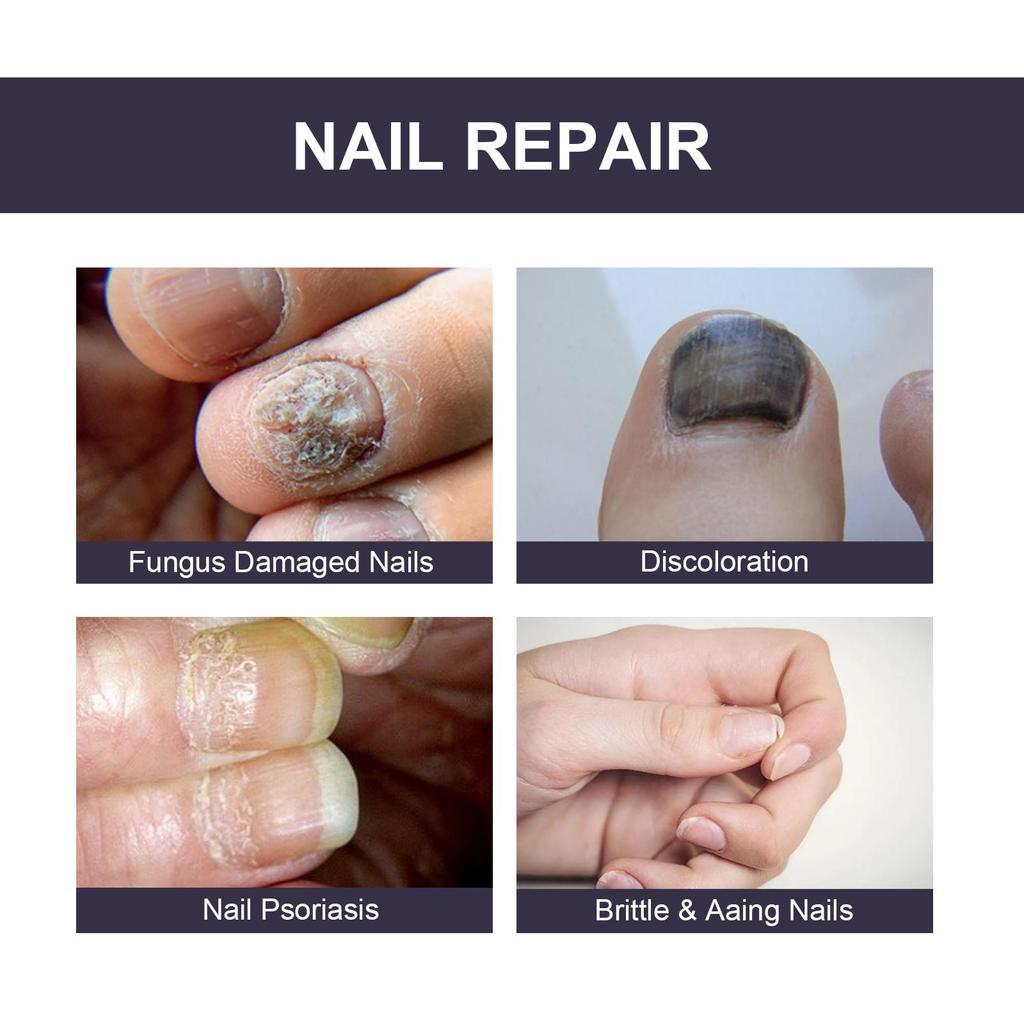 OUHOE Nail Repair Essence Soft Nail Thickening Nail Smoothing Endogenous toenail Nail Fungus Repair Essence