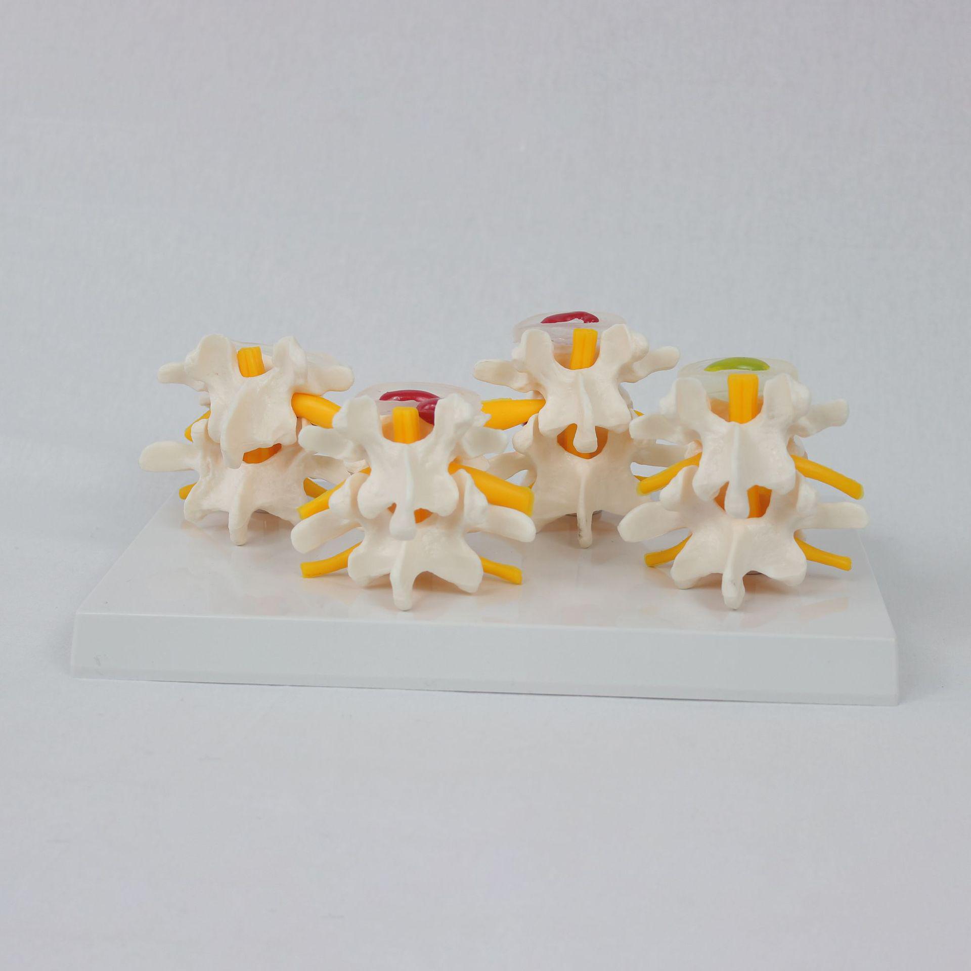 4-Stage Lumbar Vertebra Lesion Model for Orthopedic and Medical Training 27.5*16.5*9CM