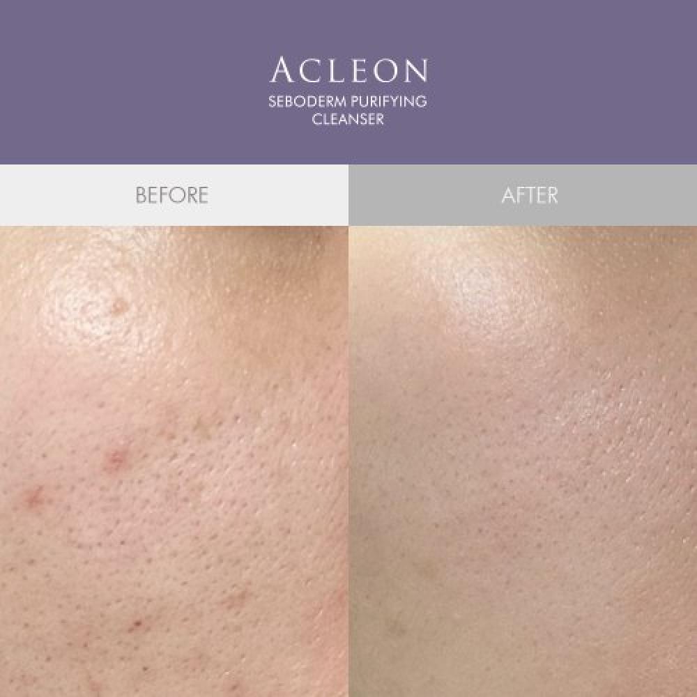 Acleon Acne Cleansing + Pore Ampule 15ml