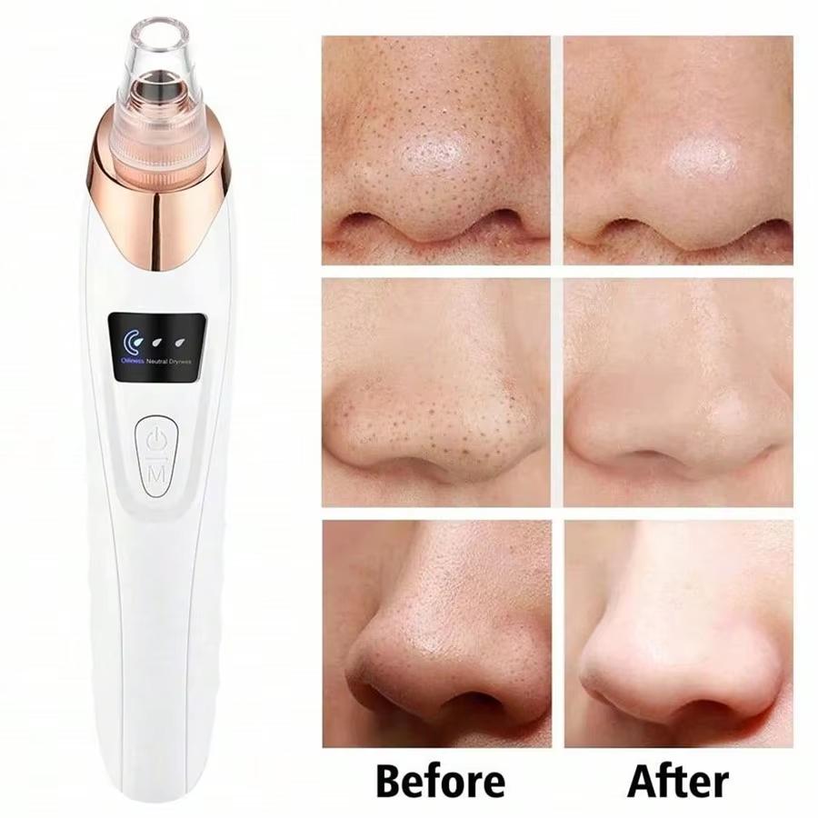 Blackhead Remover Pimple Acne Removal Blackhead Vacuum Tool Skin Care Pore Cleaner