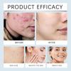 Crema Esfoliante Idratante Anti-Acne Attenua le Imperfezioni, Migliora la Texture della Pelle, Sebo e Acne, Rinfrescante e Non Grassa.