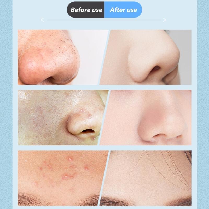 Multi Speed Pore Vacuum Cleaning Blackhead Remover For Face With Intelligent Suction Control And Reusable Tips