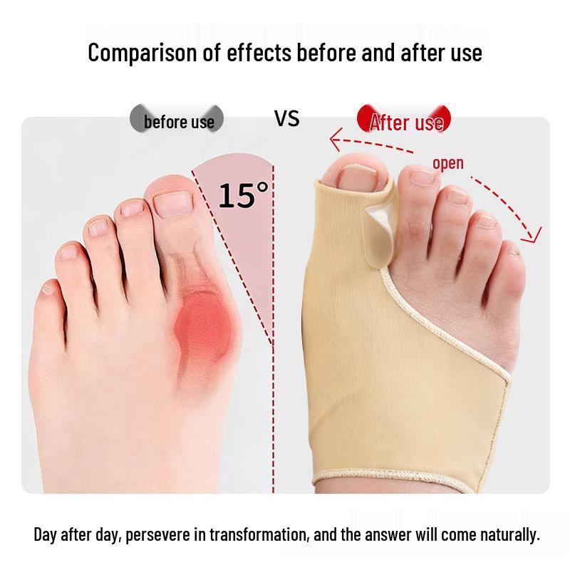 Skin-Tone Elastic Split-Toe Bunion Corrector and Hallux Valgus Soft Pad Orthotic Device