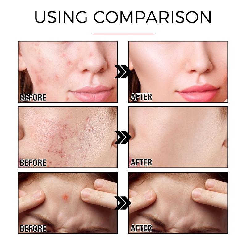 Acne Pimple Patch Repair Facial Acne Acne Cover Acne Smooth Skin Care Pimple Patch Mild Non-Irritating Skin