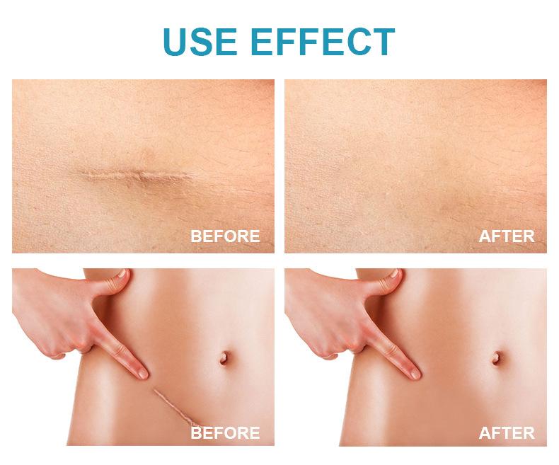 1pc Deep Whitening and Removing Freckles Melasma and Dark Spots Melanin Gel Whitening Facial Skin Care Aging Body Care