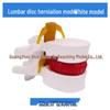 Genuine Lumbar Spine Protrusion & Vertebra Pathology Model