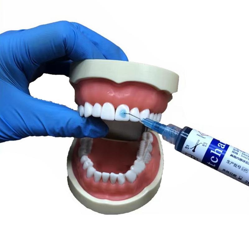 Dentalmaterial Ätzmittel 37% Phosphorsäure Ätzmittel Ätzgel Mit 5 Spitzen Für Kieferorthopädischen Klebstoff Lichthärtender Bond Zähne Kleber