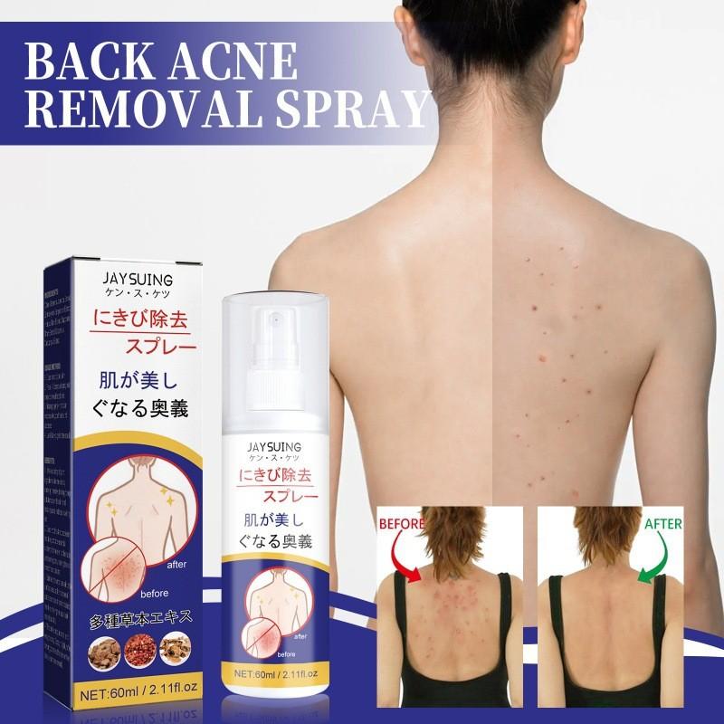 Jaysuing Back Care Spray For Fading Acne Marks And Smoothing Skin Texture