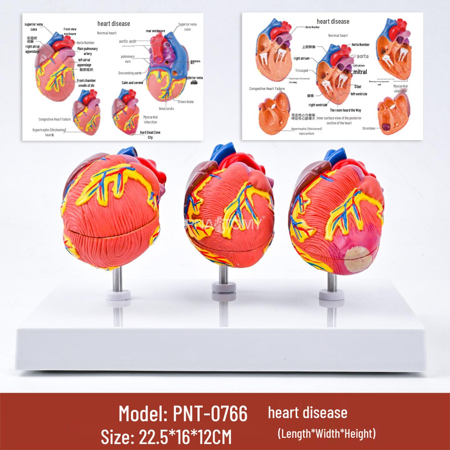 Human Heart Anatomy Model: Pathological Teaching Aid with Arterial Vessels and Heart Valves