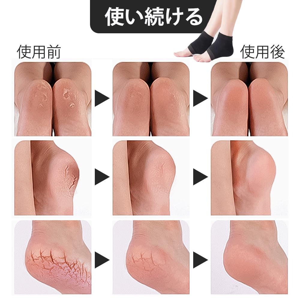 LKCCTK Heel Care Moisturizing Preventing Cracked Callus Moisturizing No Foreign Body Feel When One Size Fits Suitable for Set Socks, Heels, Heels,