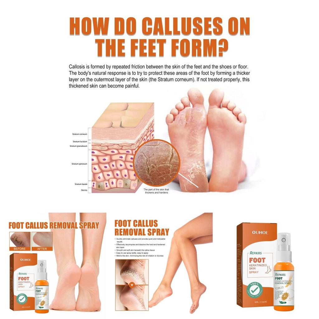 Nourishing Ouhoe Foot Spray For Softening Calluses And Cracked Heels 30ml