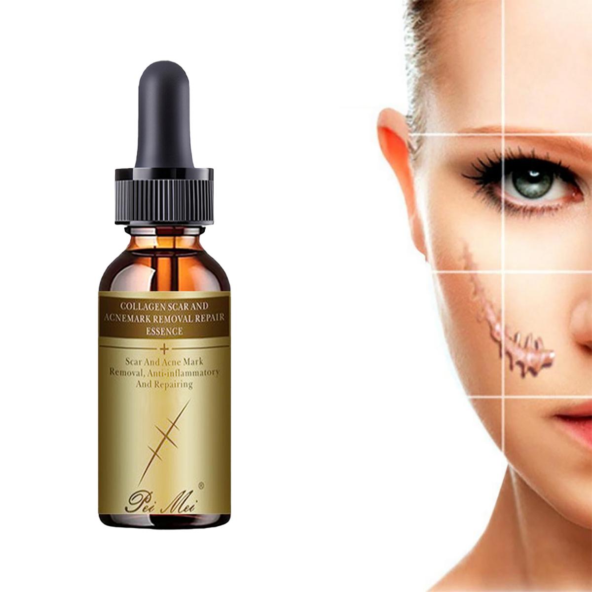 

Крем для восстановления при беременности, удаление растяжек, удаление шрамов от прыщей, крем от растяжек, лечение жировых стрий беременных, кремы для тела