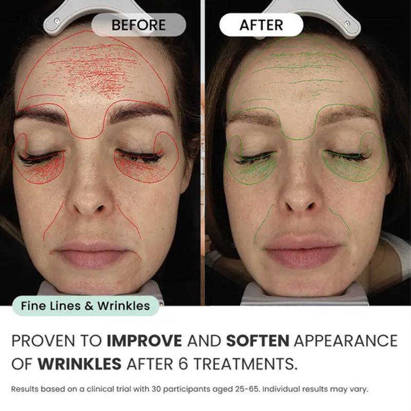Microneedling-Infusionssystem für das Gesicht gegen Falten, zur Straffung und Aufhellung