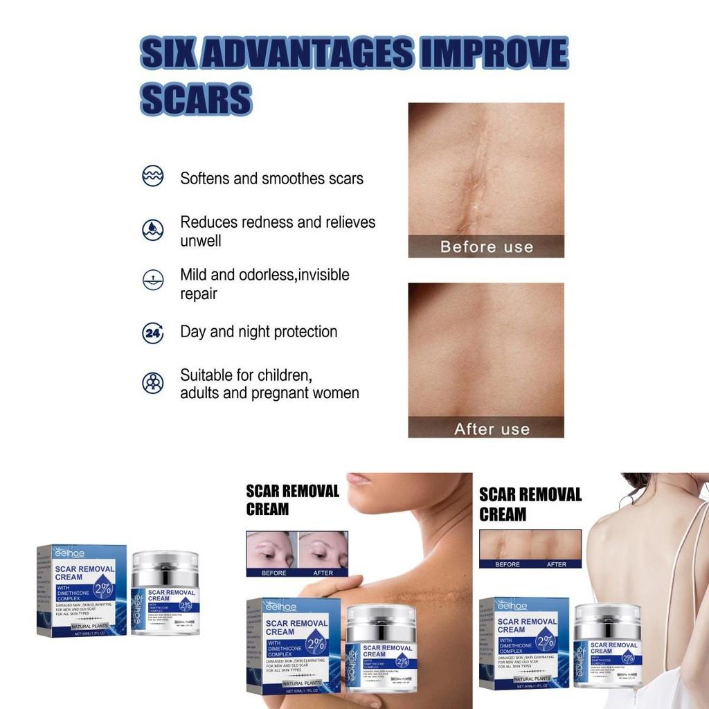 Eelhoe Scar Repair Cream For Reducing Scars And Smoothening Skin With 50ml Capacity