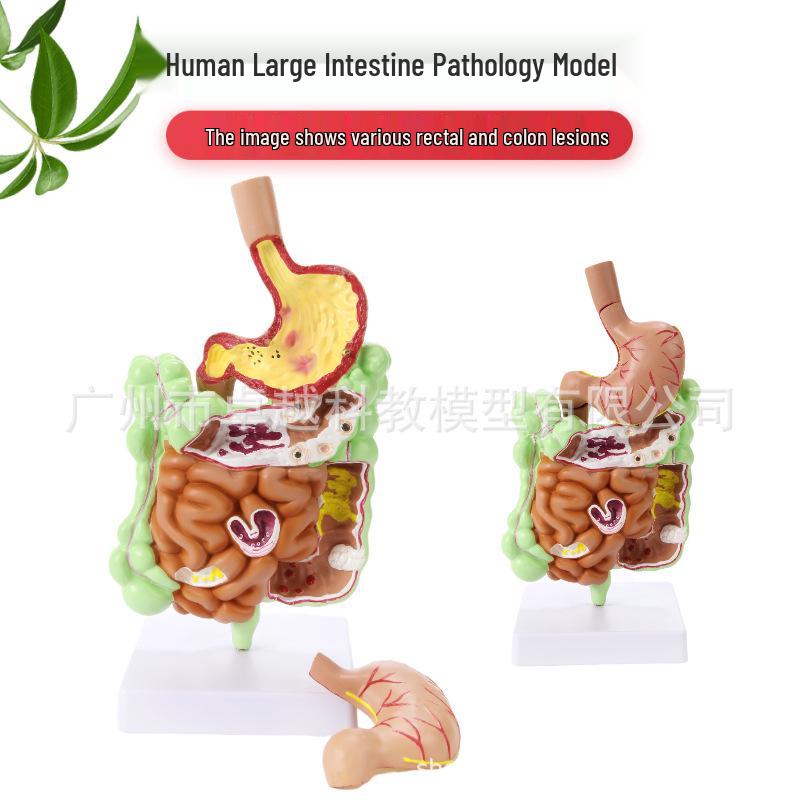 Large Intestine Pathological Model: Gastrointestinal Anatomy with Cecum, Rectum & Duodenum
