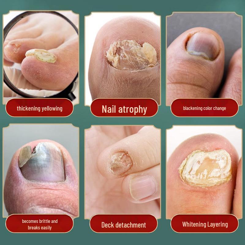 Onychomycosis Relief Lotion: Soothes Discomfort, Reduces Nail Atrophy & Thickening