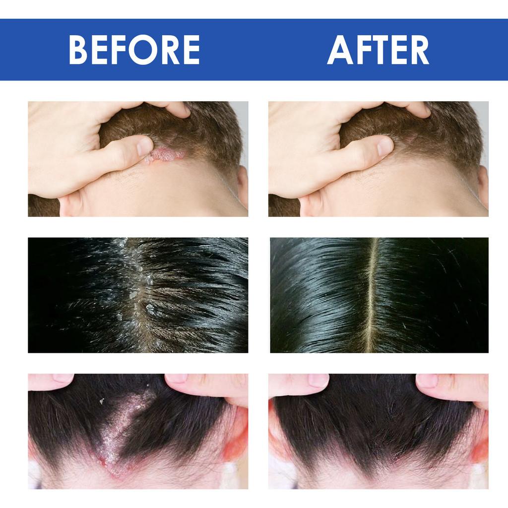 South Moon Seborrheic Dermatitis Cream Effective Relief For Scalp And Skin Problems