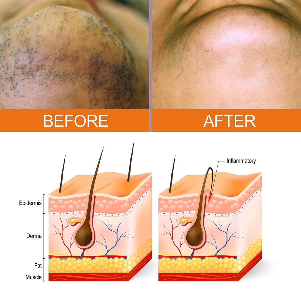 30 ml Essens-Vokser Inne i Håret, Reduserer Rødhet, Forhindrer Hår i å Vokse Innover, og Lindrer Etter Skjeggessenser