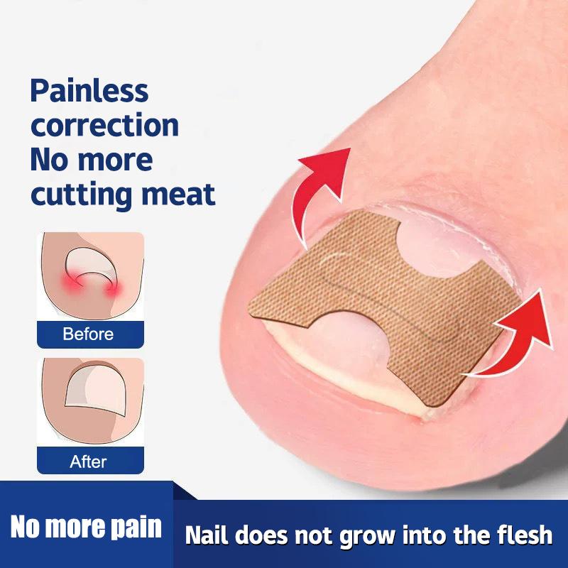 Ingrown Toenail Toe Correction Stickers Paronychia Treatment Recover Corrector Patches Feet Care Paronychia Treatment Recover