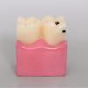 Modello Carie Dentale 6 Volte Malattia Denti Modello Dentale per Dimostrazione Dentale Modello Insegnamento Dentista Laboratorio Dentale Ricerca Orale