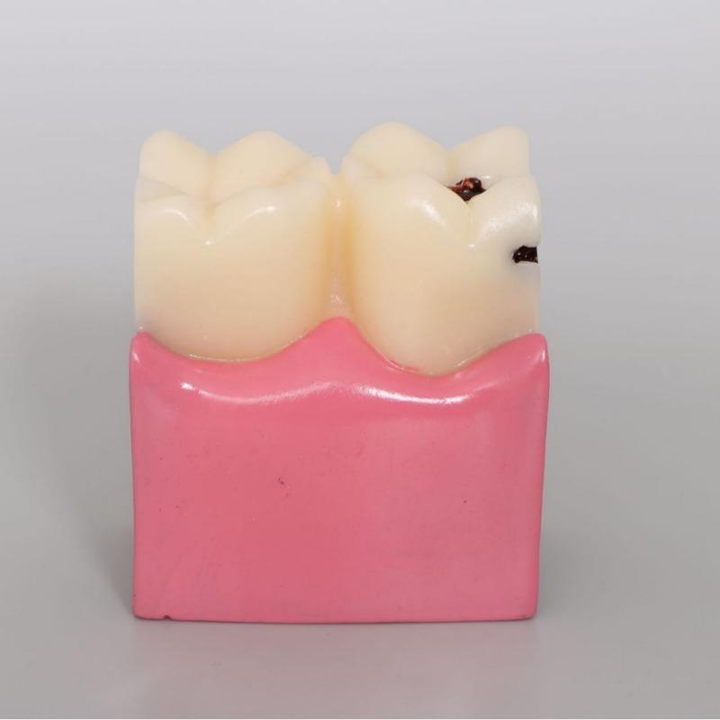 Modello Carie Dentale 6 Volte Malattia Denti Modello Dentale per Dimostrazione Dentale Modello Insegnamento Dentista Laboratorio Dentale Ricerca Orale