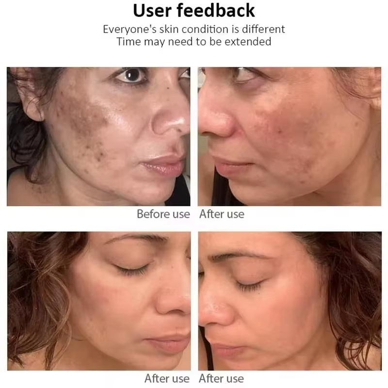 Crème blanchissante puissante anti-taches Éclaircit la peau rapidement Élimine la pigmentation mélanique Mélasma Taches brunes Soin de la peau coréen