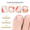 Nickel-Titanium Ingrown Toenail Corrector: Invisible, Wearable Nail Hook for Pain Relief