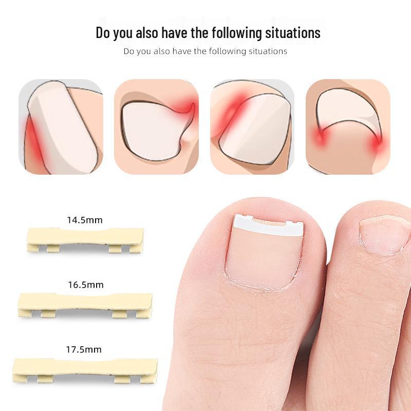 Nickel-Titanium Ingrown Toenail Corrector: Invisible, Wearable Nail Hook for Pain Relief