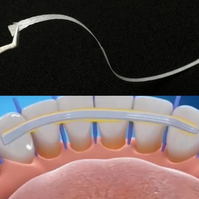 Lot de 7 bandes de fixation pour dents lâches en fibre de verre, matériau dentaire flexible, fixation par photopolymérisation, fixation orthodontique