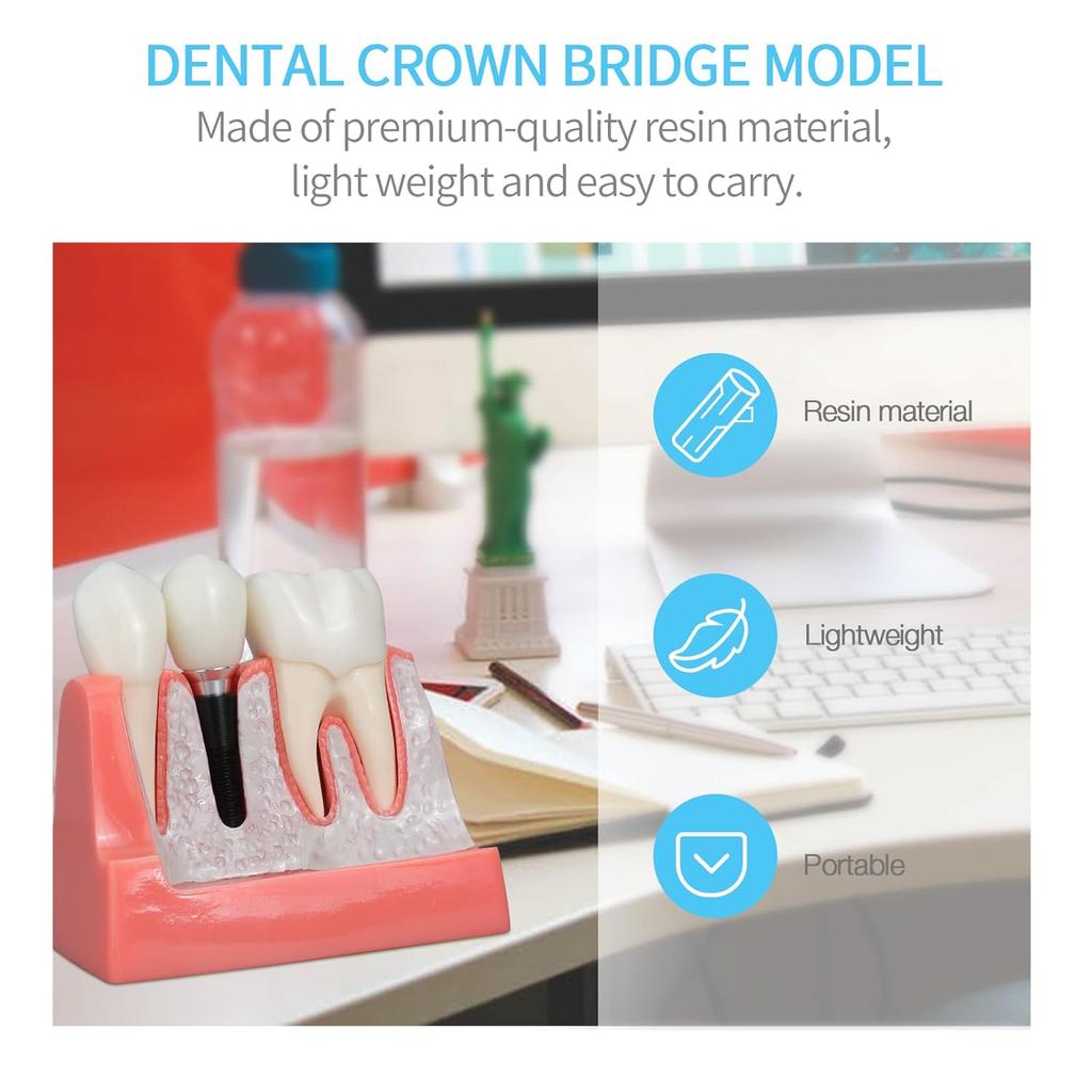 ANNWAN Dental Implant Model 4 Times Removable Analysis Crown Bridge Demonstration Teeth Model for Class Education and Studying Teeth Model