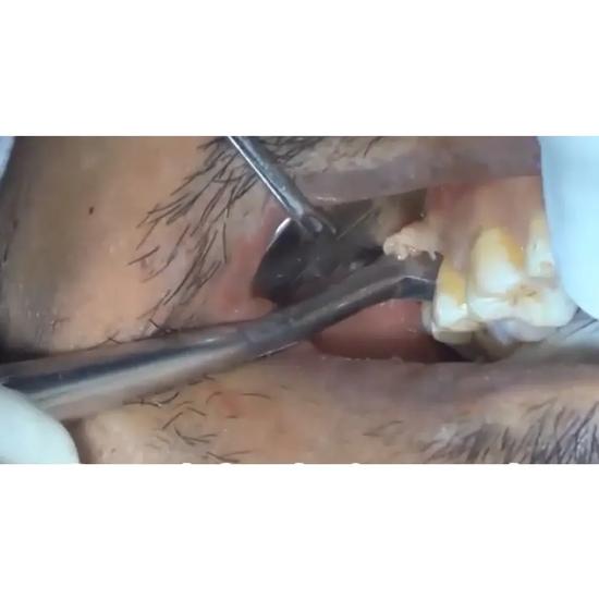 GDC Root Elevators Cryer - Right Standard (Ea31)