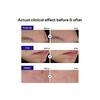Mediheal Derma Clear Madecassoside Blemish Patch (44 Patches) - Acne Spot Protection, Fast Healing With Madecassoside & Niacinamide