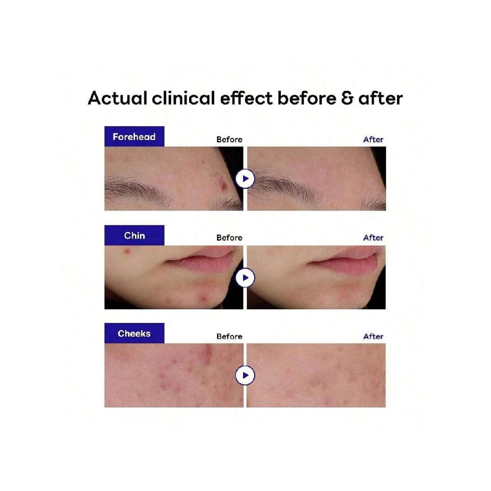 Mediheal Derma Clear Madecassoside Blemish Patch (44 Patches) - Acne Spot Protection, Fast Healing With Madecassoside & Niacinamide