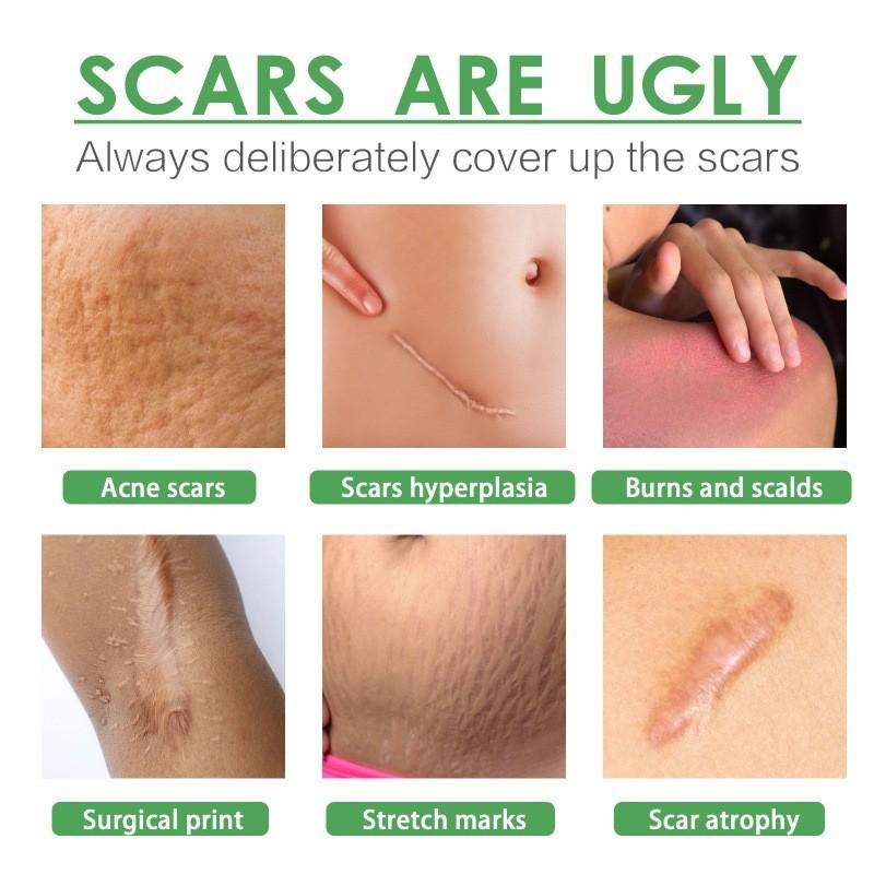 Ouhoe Scar Repair Serum For Smooth Skin Reduces Scars From Surgery And Pregnancy 30ml