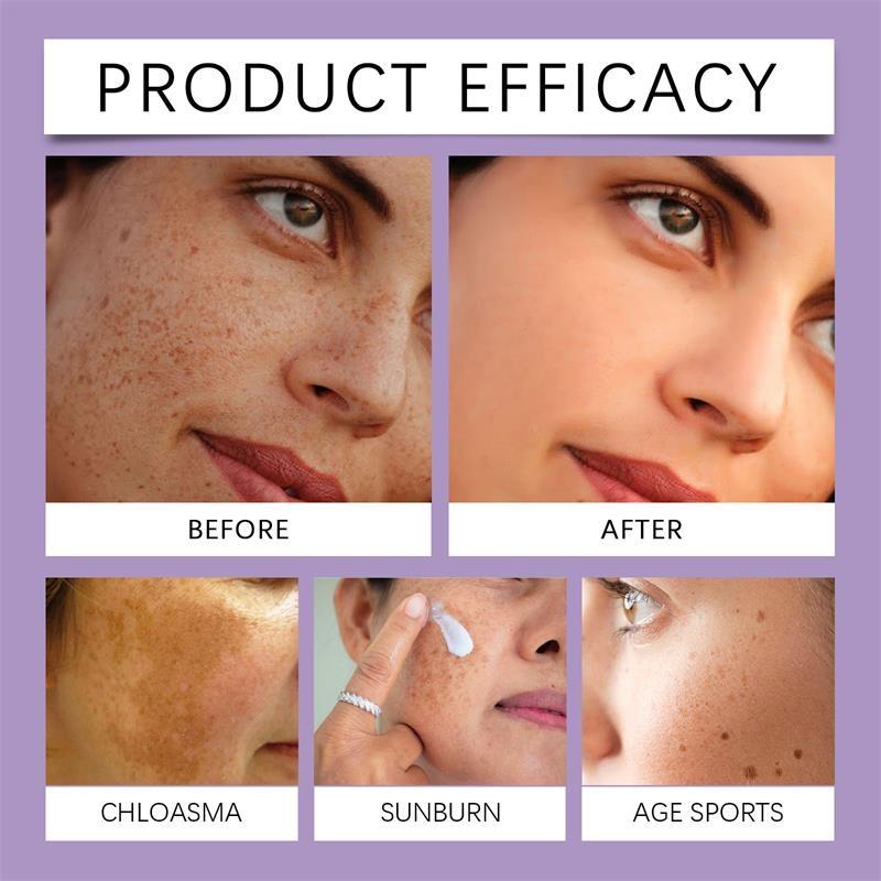 Freckle Whitening Cream Melasma Dark Spots Pigmentation Removal Product Fade Stain Melanin Fast Repair Brighten Korean Skin Car