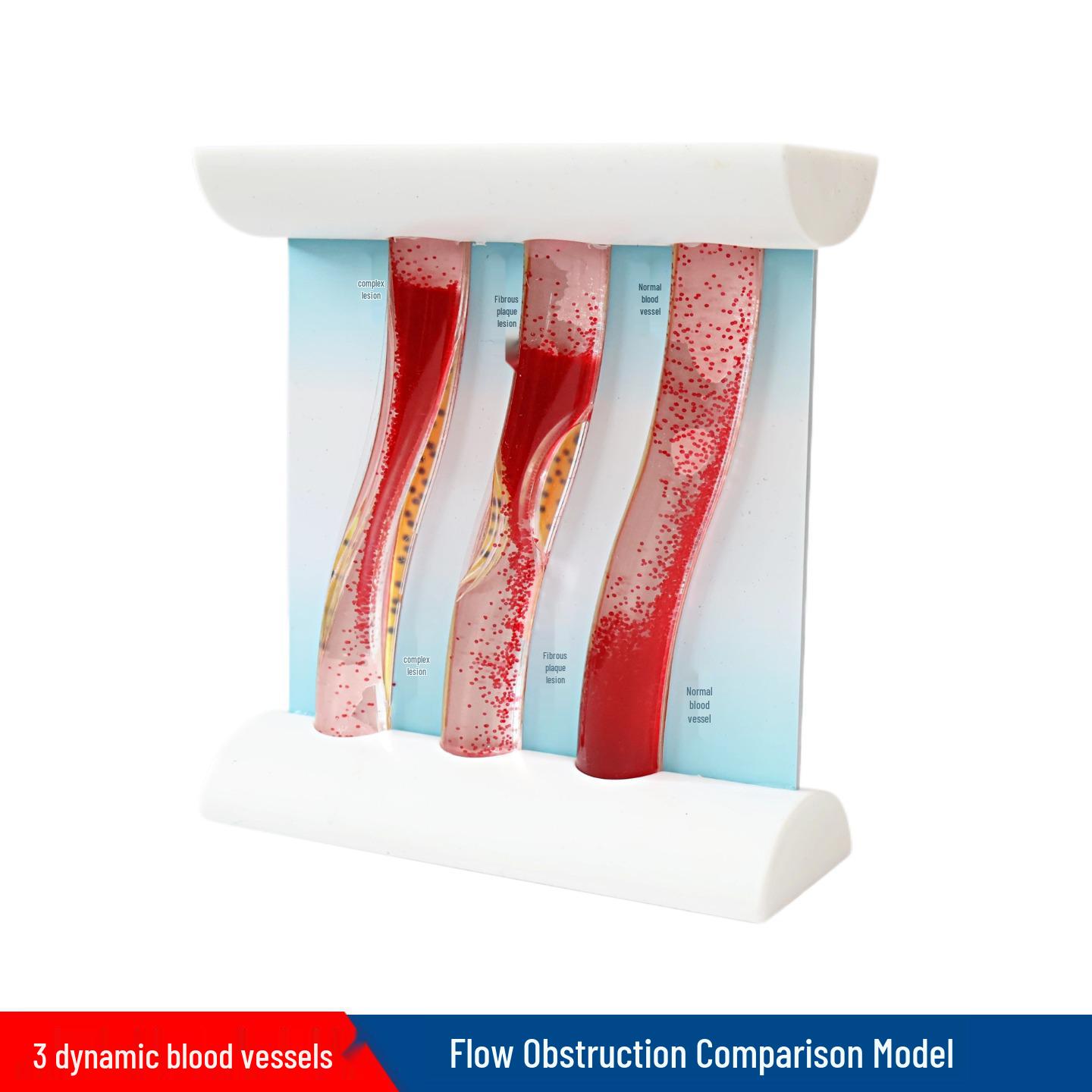 Dynamic Blood Vessel Model for Teaching: Lipid Viscosity, Flow Blockage, Plaque, and Thrombosis Pathology