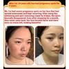 Whitening and Freckle Removing Cream Face Cream Lightening and Removing Spotles Sunburn Brightening Skin Color