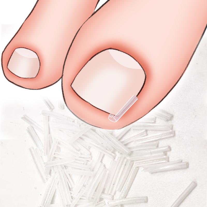 50 ks/krabička Korekční pásky na zarostlý nehet Paronychie Korekce Rovnací rovnátko Léčba nehtu na noze Rýha Nástroje na pedikúru