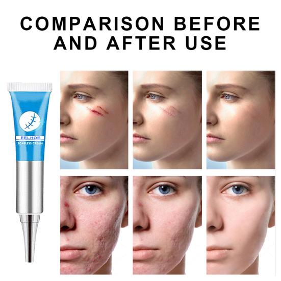 Cream Effective Natural Plant Extracts Scar Soften Repairing Remover Gel for Beauty