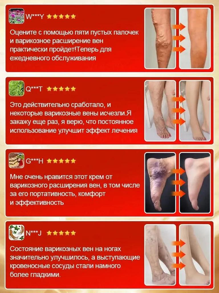 Petzoshenk German Varicose Veins Leg Veins Bulge Dilated Red Blood Cold Compress Gel