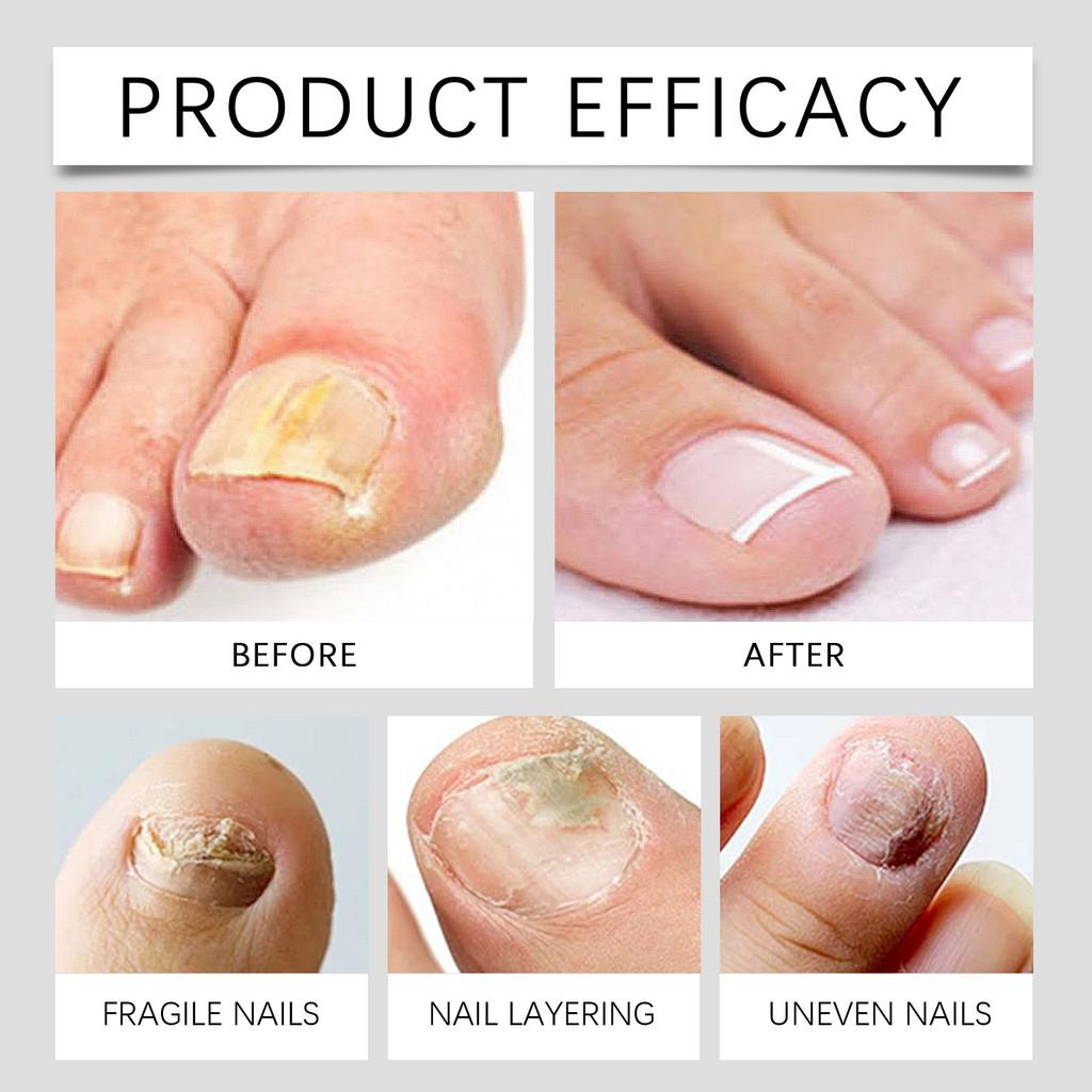 Ximonth Nagelpflege-Stift Nährende und feuchtigkeitsspendende Behandlung für gesunde Nägel