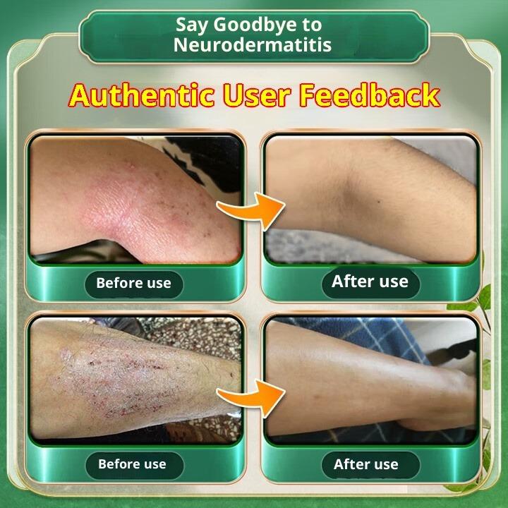 Urticaria ointment anti-allergic and anti-itching cream